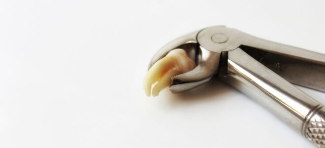 Everything to Know Before Getting a Wisdom Tooth Removal