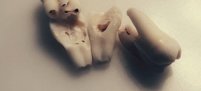 Is Your Mouth a Time Bomb? The Shocking Truth About Silent Tooth Decay